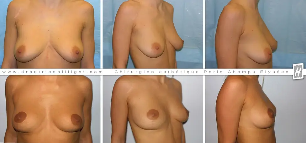 photos de resultat avant après de réhaussement mammaire par le DR Patrice Hilligot chirurgien esthetique à Paris