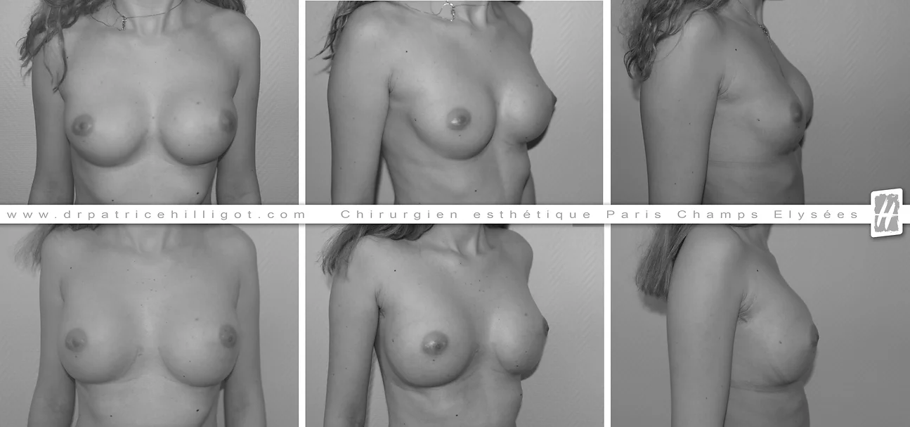 photos de resultat avant après de changement de prothèses mammaires par le DR Patrice Hilligot chirurgien esthetique à Paris