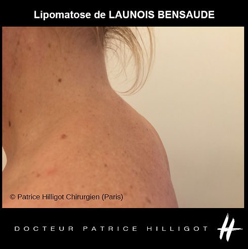 lipome-maladie de LAUNOIS BENSAUDE.jpg