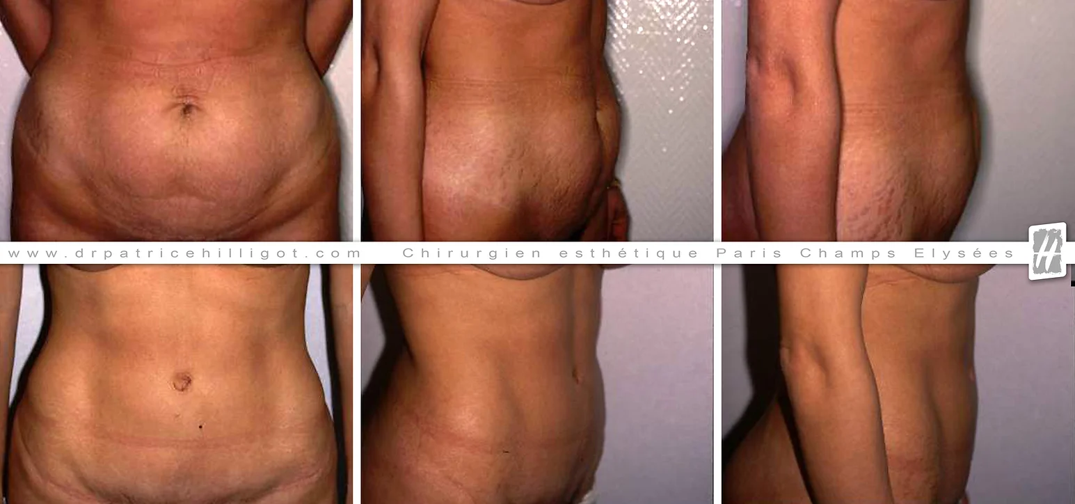 abdominoplastie femme