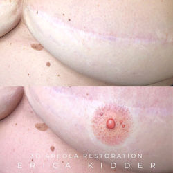 3d areola restoration