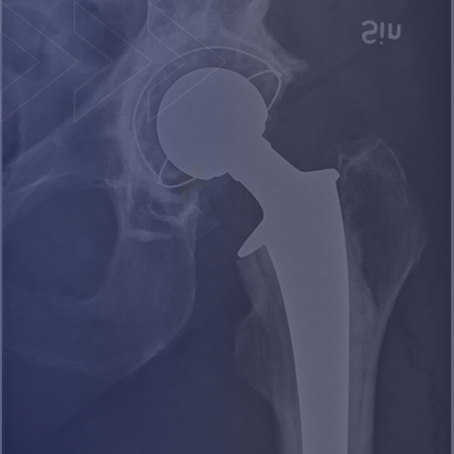 Sleeping after total hip replacement (weeks 1–6): positions, pillows, and what actually helps!