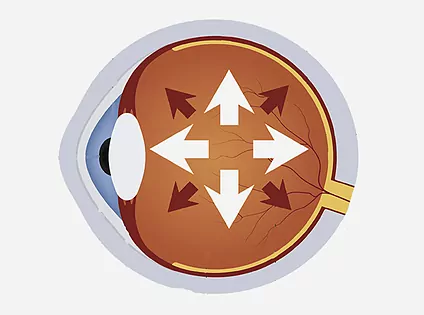 Tensión intraocular, qué es y cómo diagnosticarla