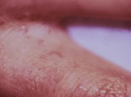 Los dermatólogos advierten de que los tratamientos contra la sarna están perdiendo eficacia