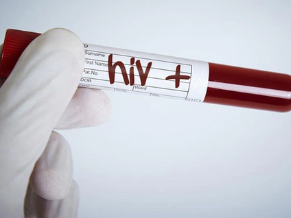 realizan importante hallazgo en la lucha contra el VIH: logran frenar multiplicación del virus 