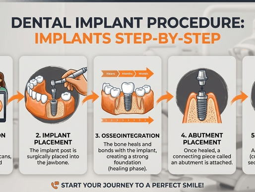 Dental Implant Procedure: Implants Step-by-Step