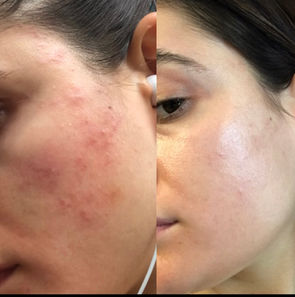 Image of a girl before and after healing her skin using the Get Glow Method