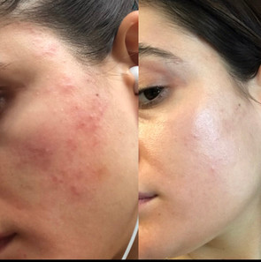 Image of a girl before and after healing her skin using the Get Glow Method