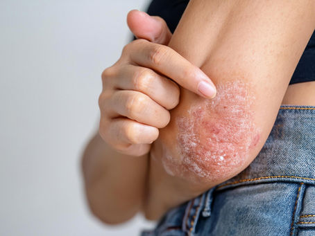 Psoríase e Stress: como fatores psicológicos influenciam a doença