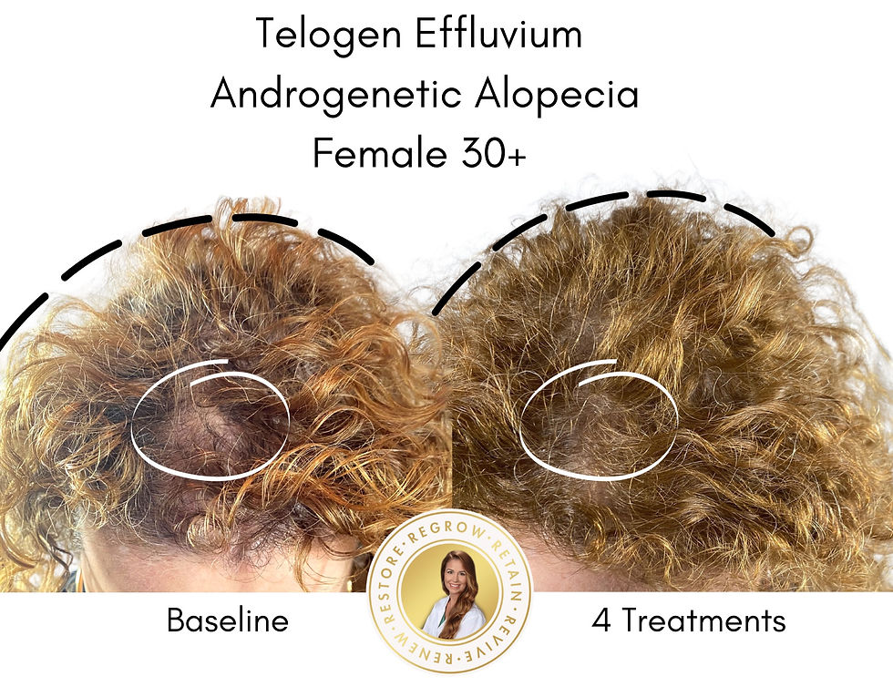 Alma TED Before and After 4 hair loss treatments for Androgenetic Alopecia
