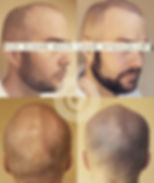 Scalp Micro Pigmentation Scar Camouflage
