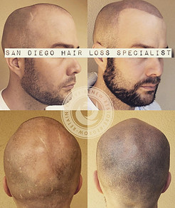 Scalp Micro Pigmentation Scar Camouflage