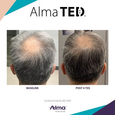 ALMA_Treatment_Result_4