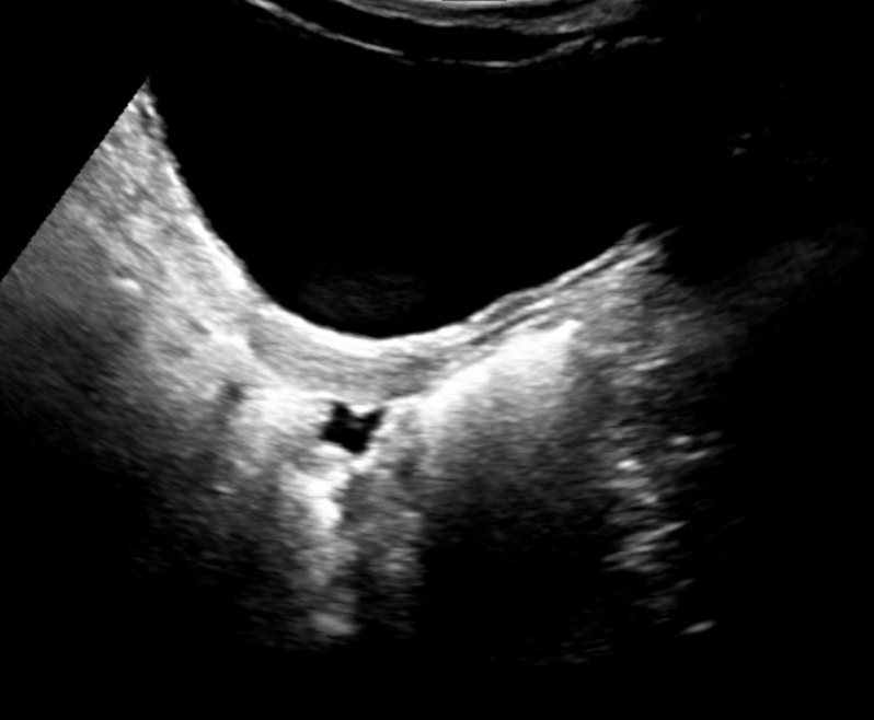 Utero prepubere