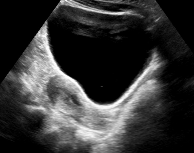 Utero normale