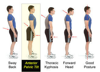 Faulty+Posture.jpeg