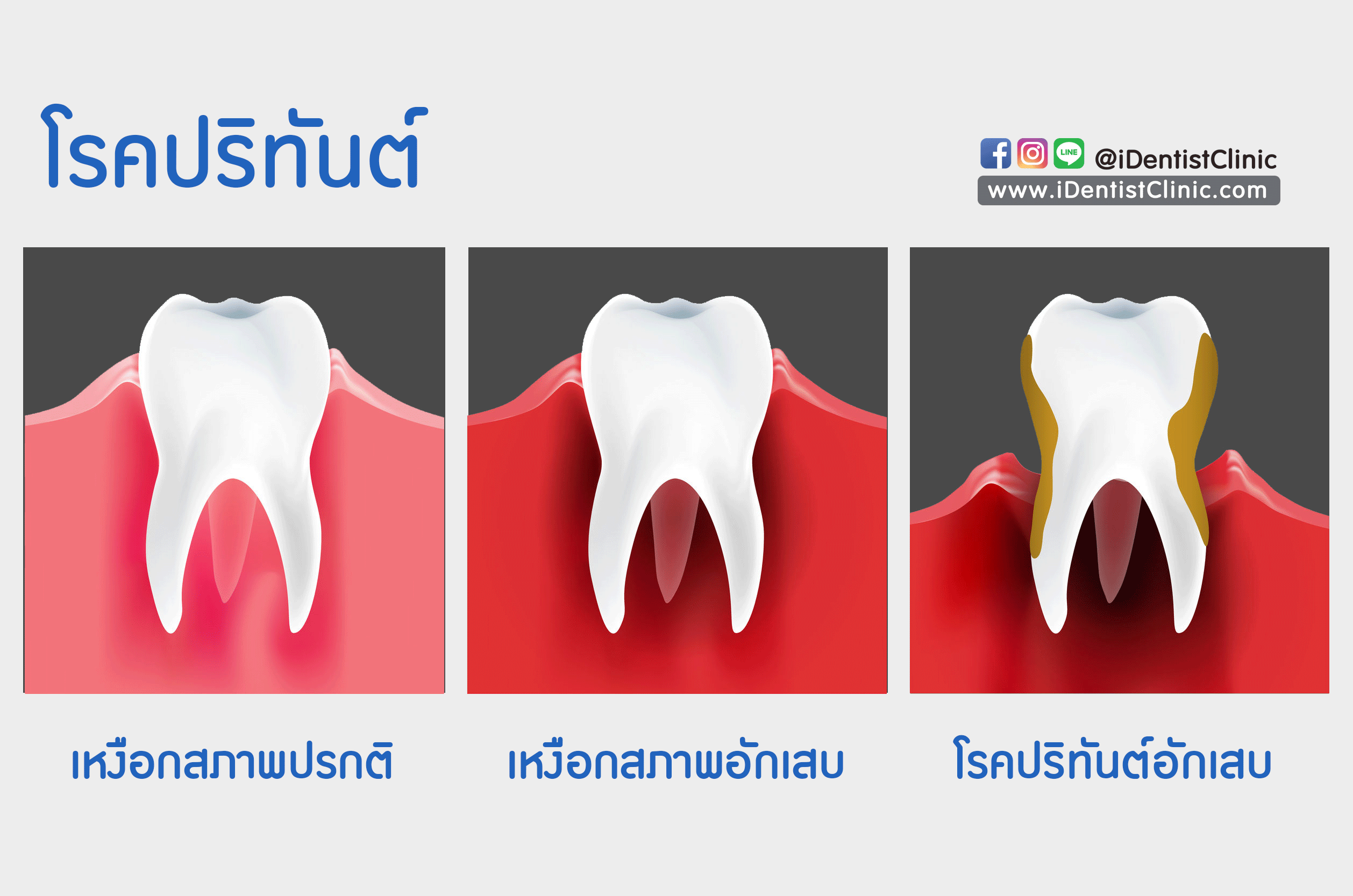 ปริทันต์อักเสพ.gif