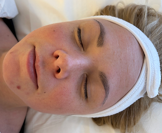 Hollywood Carbon Peelings im Skinlaser Studio in Winterthur – eine innovative Laserbehandlung für strahlende und glatte Haut