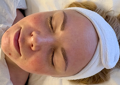 Hollywood Carbon Peelings im Skinlaser Studio in Winterthur – eine innovative Laserbehandlung für strahlende und glatte Haut