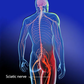 Find Relief from Sciatica with New York Upper Cervical Chiropractic