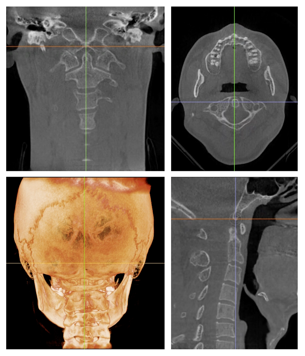 3D CBCT views
