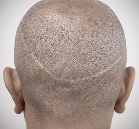 fut-hair-transplant-scar_edited.webp