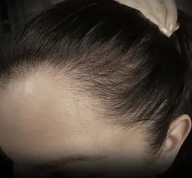 female-thinning_edited_edited_edited.webp