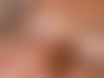 Trådløft under øynene