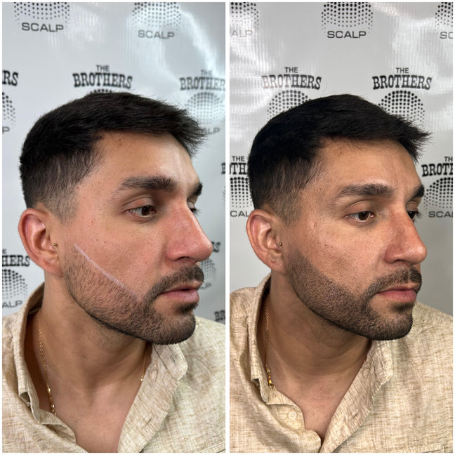Beard Enhancement with Scalp Micropigmentation Before and After