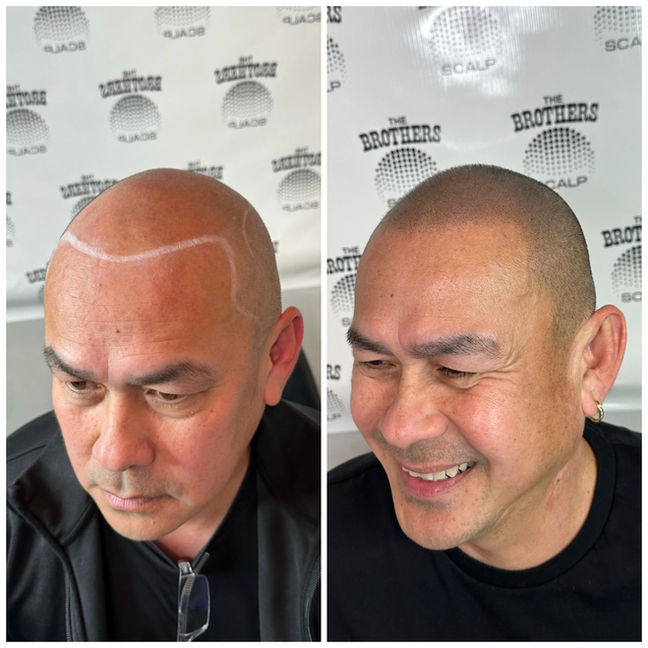 Blended Hairline Scalp Micropigmentation Before and After