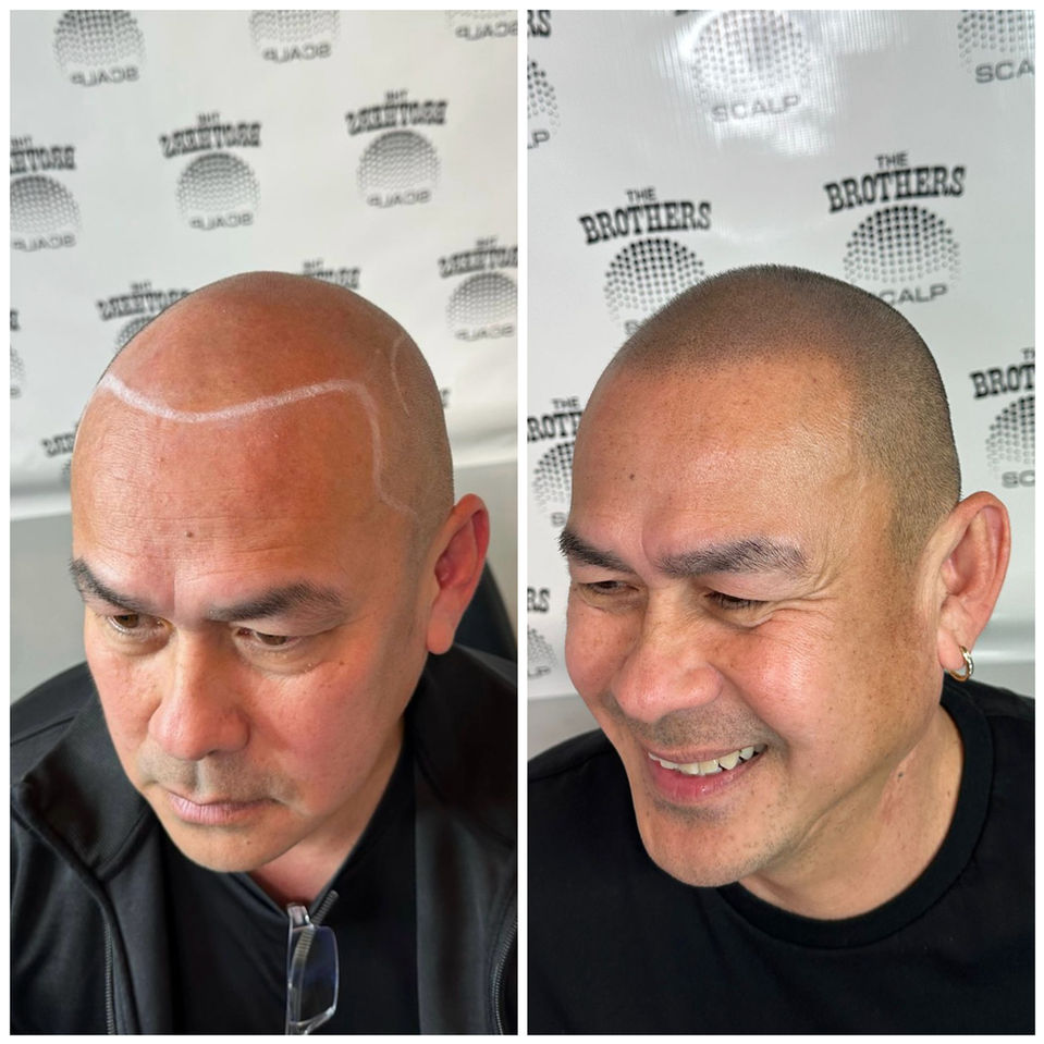 Blended Hairline Scalp Micropigmentation Before and After