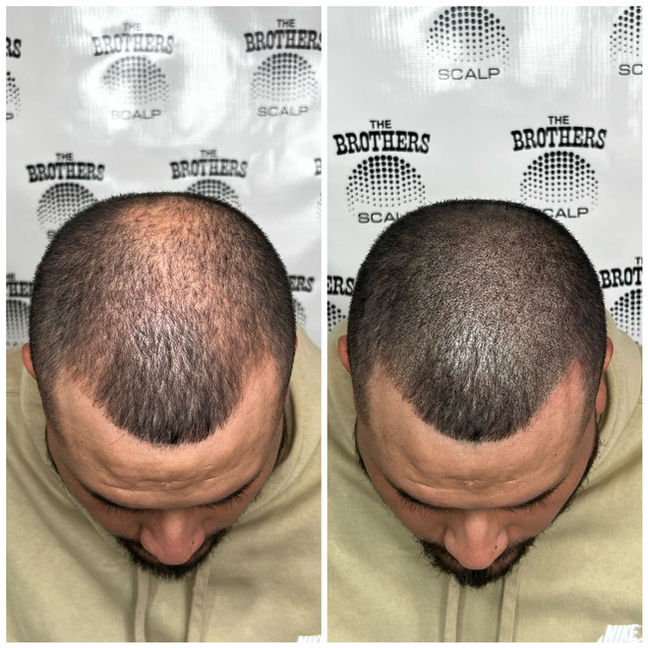 Scalp Micropigmentation for Crown Thinning Before and After