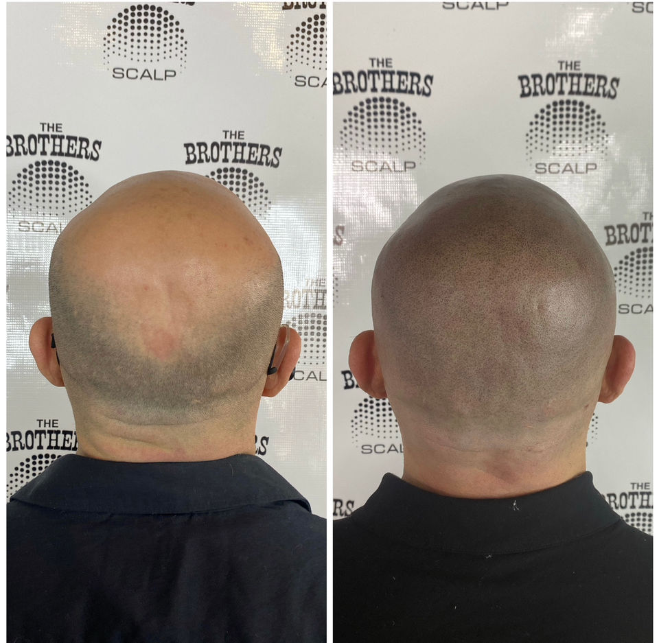 Total Alopecia Scalp Micropigmentation Coverage