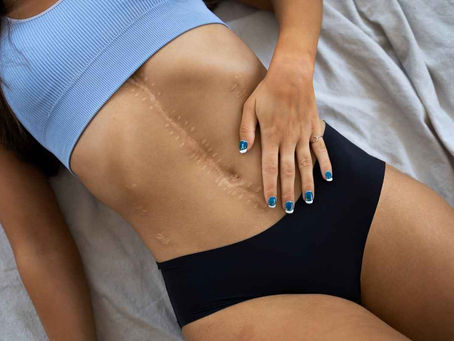 Does Liposuction Leave Scars? What to Expect After Surgery