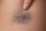 Close-up of a bruise on skin, with a finger gently pressing it. The bruise is dark purple with blurred edges, showing minor swelling.