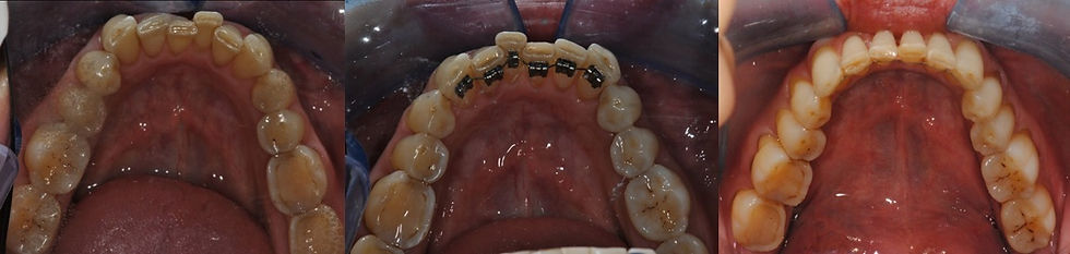 Lingual orthodontics