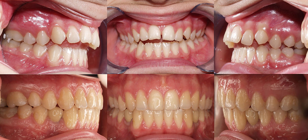 Adolescent Orthodontics