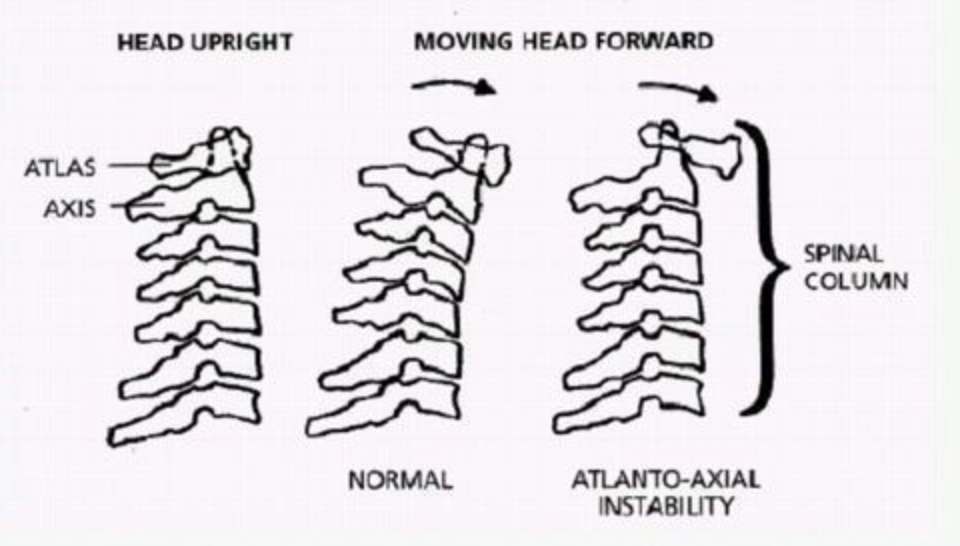 Understanding AAI in Down Syndrome Fitness