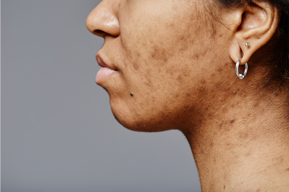 Irritated and scarred BIPOC skin