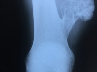 Osteocondroma