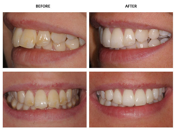 Teeth Whitening