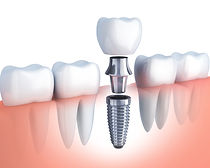 Implant Now #SmileMovement.jpeg