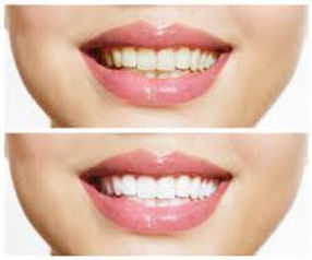 Teeth Whitneing 