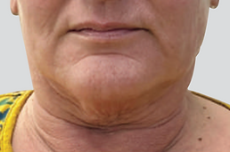 Neck Lift Before.png