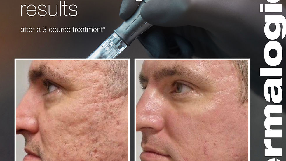 Before and after microneedling results on a man's face, showing improved skin. Gloved hand holds microneedling pen. Text: "PRO microneedling results."