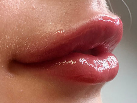 Lip Filler at No1 Urban Aesthetics Newcastle-under-Lyme Benefits Risks and Results
