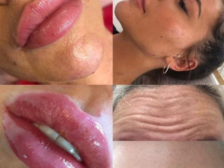 before and after pictures of anti ageing treatments