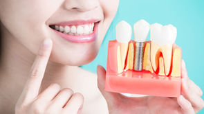 Professional Dental Implants for Permanent Tooth Replacement