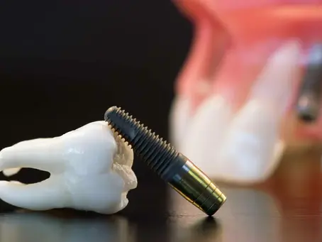 Complete Dental Implants Solutions for Missing Teeth