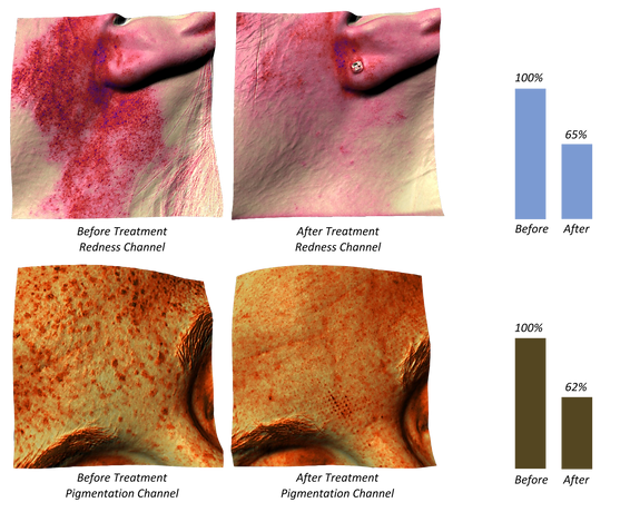 Follow Up Redness and Pigmentation with